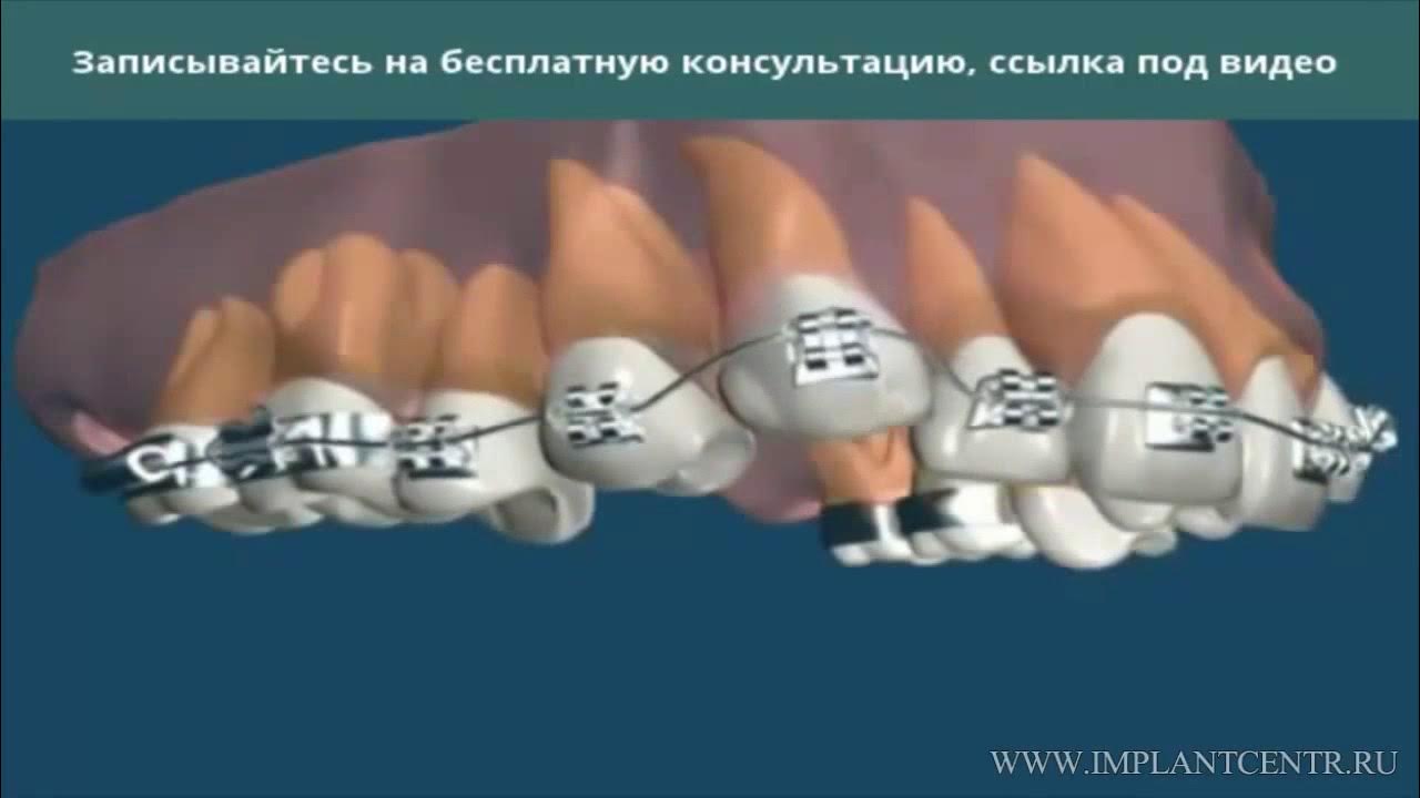 Индивидуальный проект брекет системы Безлигатурная керамическая брекет система - YouTube