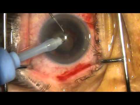 Cataract surgery in real-time Operacija katarakte dr Dragan Martinovic