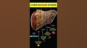How Liver Disease Develops Over Time — Stage by Stage | Fatty Liver | Liver Cirrhosis