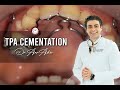 TPA transpalatal arch cementation in orthodontics