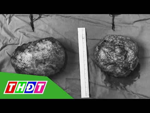 Video Người phụ nữ ở TP. HCM bị vỡ túi độn ngực | THDT - youtube