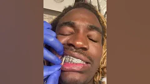 Getting braces extra wire put on .