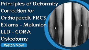 Principles of Deformity Correction for Orthopaedic FRCS Exams | Malunion| LLD | CORA | Osteotomy