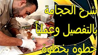 الحجامة خطوة بخطوة وبالتفصيل  (شفاء امتى في شرطة محجم ) (Cupping step by step and in detail( hijama