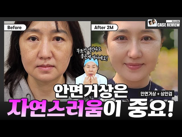 [케이스리뷰 20화] 안면거상하고 사진찍는게 행복해 졌어요 #안면거상 #상안검 #리프팅