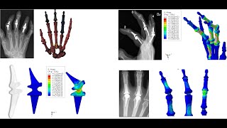 Modeling & predicting fatigue life for silicone(H-elastic) PIP finger implant using Abaqus & Fe-safe