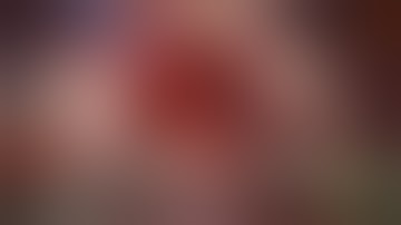 Asvide: Robotic left S9-10 lung segmentectomy step by step