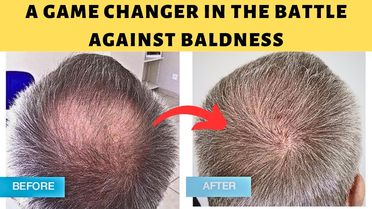 How To Stop Hair Loss? Profolan Hair Loss cure Supplement Review 