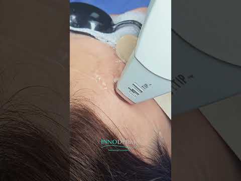 🎬 Video relacionado con gafas de depilación láser de Media Markt