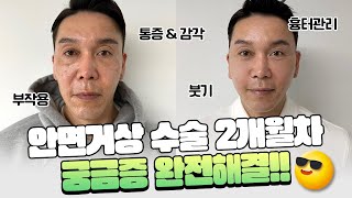 50대 안면+목거상 리얼후기! 성형 후 2개월차 경과기록까지!✨