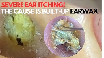 Why Does Your Ear Keep Itching? The Surprising Truth About Earwax!  ASMR