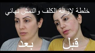 ازالت نمش ولكلف نهائيا من الجسم او الوجه 