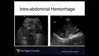 POCUS in Shock 5 - Hemorrhagic