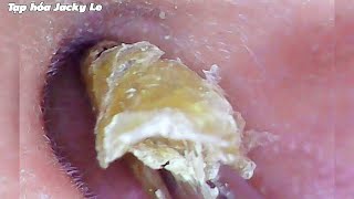 Ear Wax Removal #70: The Biggest Piece Of Earwax, Thick And Dry | Ear Cleaning ASMR