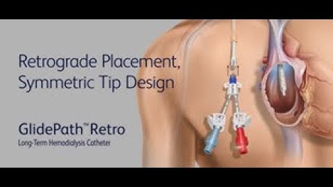 BD GlidePath™ Retro Long-Term Hemodialysis Catheter Procedural Animation (no audio)