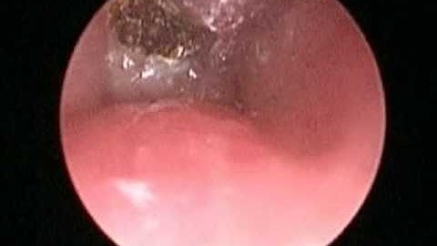 Suprastomal Tracheal Fibroma with the OmniGuide CO2 Laser Fiber