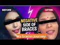Negative side of braces😭|before vs after facial profile |my braces journey 😭