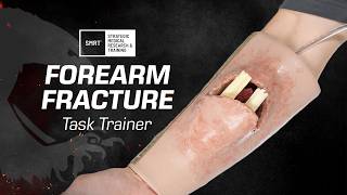 Addressing a Broken Arm with the SMRT™ Forearm Fracture