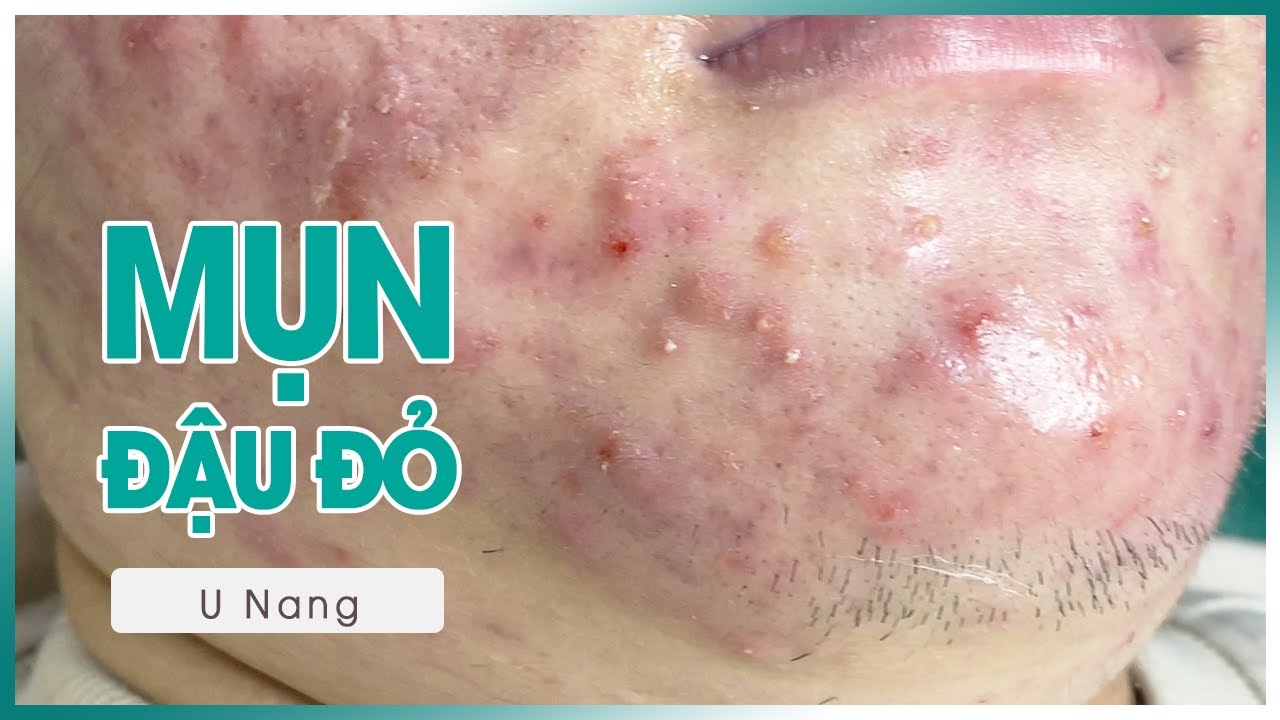 Điều Trị Mụn Đậu Đỏ Sau 30 Ngày Tại Hana Spa Gò Vấp
