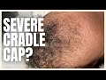 TRY THIS FOR SEVERE RECURRING CRADLE CAP! | Brittney Gray