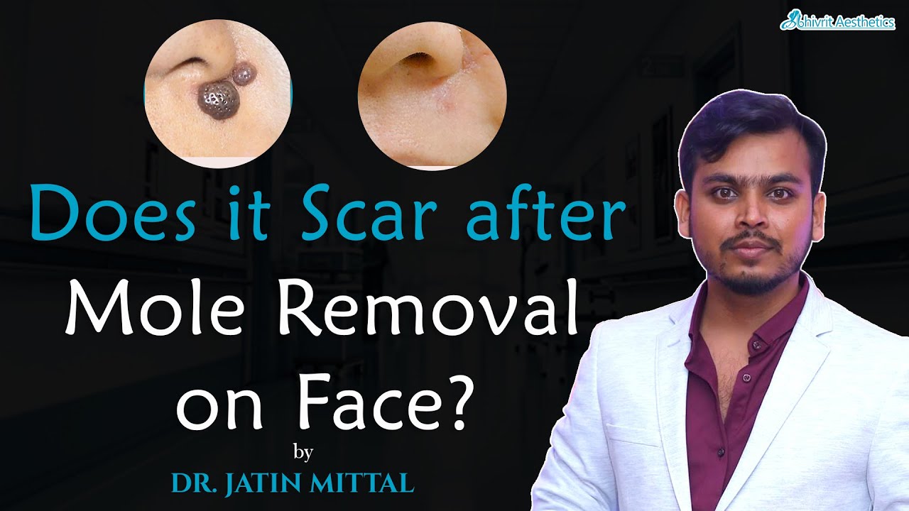 Does it scar after mole removal on face ? by Dr. Jatin YouTube