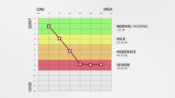 Hear.com - How to Read an Audiogram