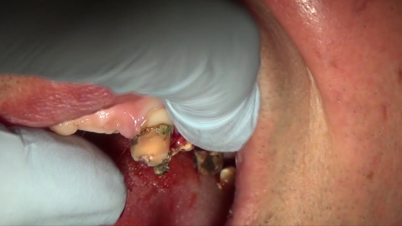 Removal of the tooth with bone attached to it,ankylosis