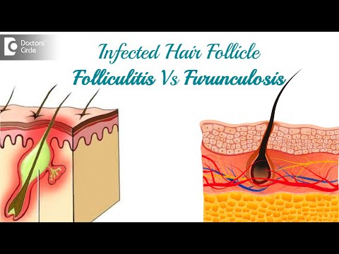 Infected hair follicle. What to do? Causes, Location, & Treatment-Dr. Rasya Dixit | Doctors&rsquo; Circle