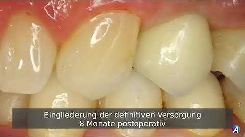 DE Klinisches Video Axiom X3® - Dr. Monnot