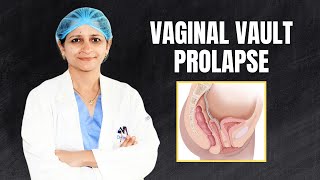 Vaginal & Vault Prolapse After Hysterectomy: Causes, Symptoms & Treatment