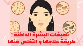 علاج البقع الداكنة في الوجه shorts خلطات_طبيعية