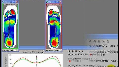 Identifying Asymmetry in Gait Using In-Shoe Pressure Mapping Technology