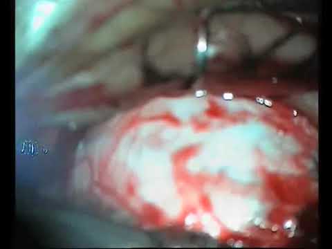 Optic nerve sheath decompression step by step , step 5 , the nerve sheath incisions