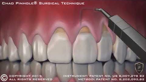 Animation of Pinhole® Surgical Technique
