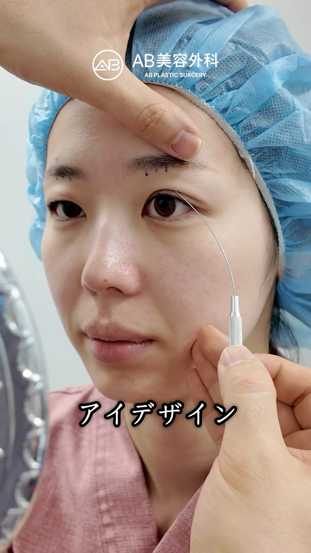 1ヶ月でここまで変わる？自然癒着の最終経過！ | AB美容整形