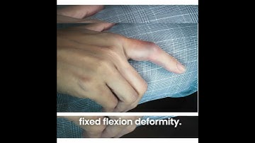 Buddy taping a PIP joint injury can cause a fixed flexion deformity, where it’s unable to..
