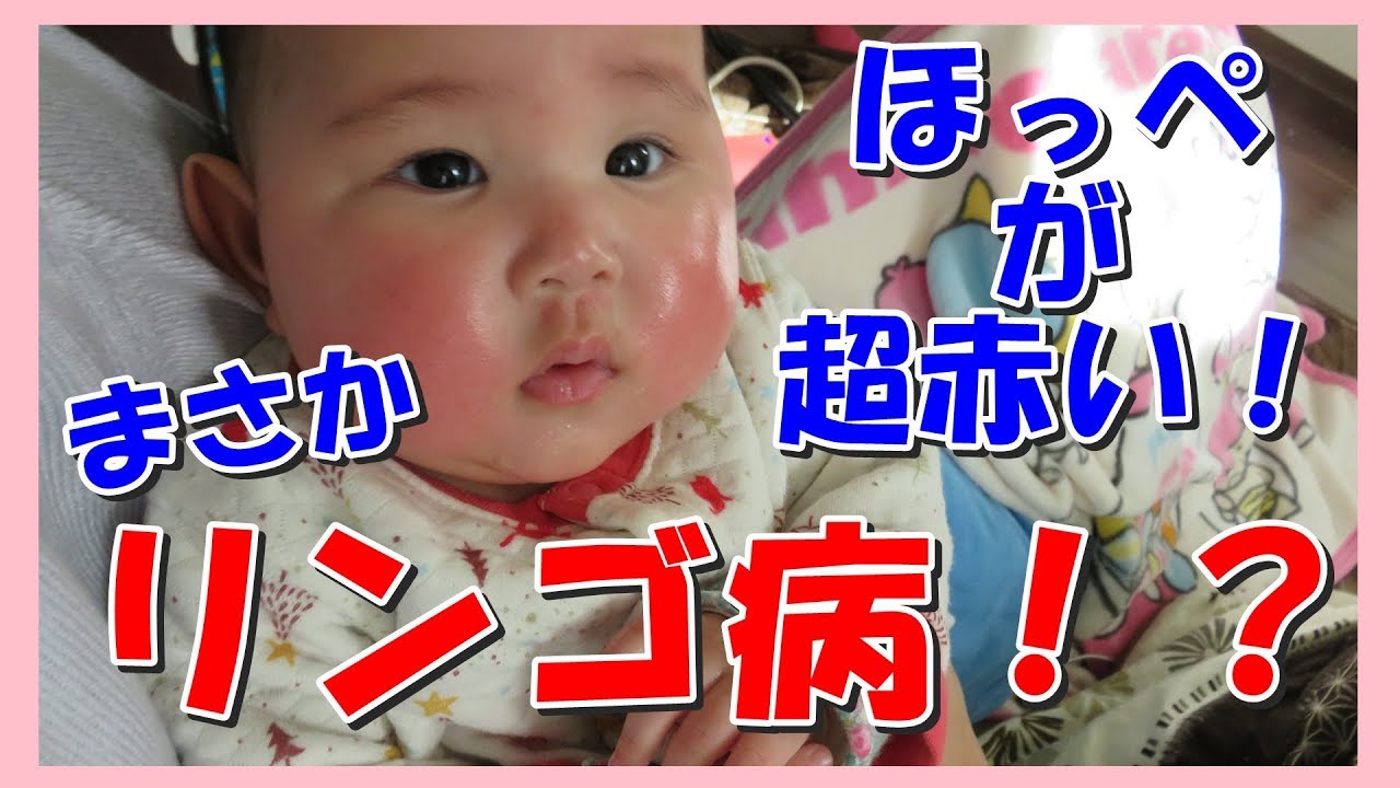 赤ちゃんのほっぺが赤い原因は りんご病の疑い さとちん生後４か月半 Youtube