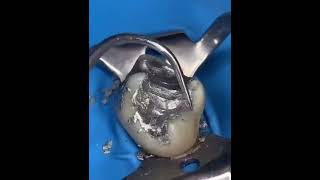 Amalgam Filling 1 Amalgam Filling Cl1 Filling Tooth Restoration