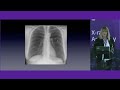 Digital Tomosynthesis in Thoracic Diseases | X-ray Academy 2024