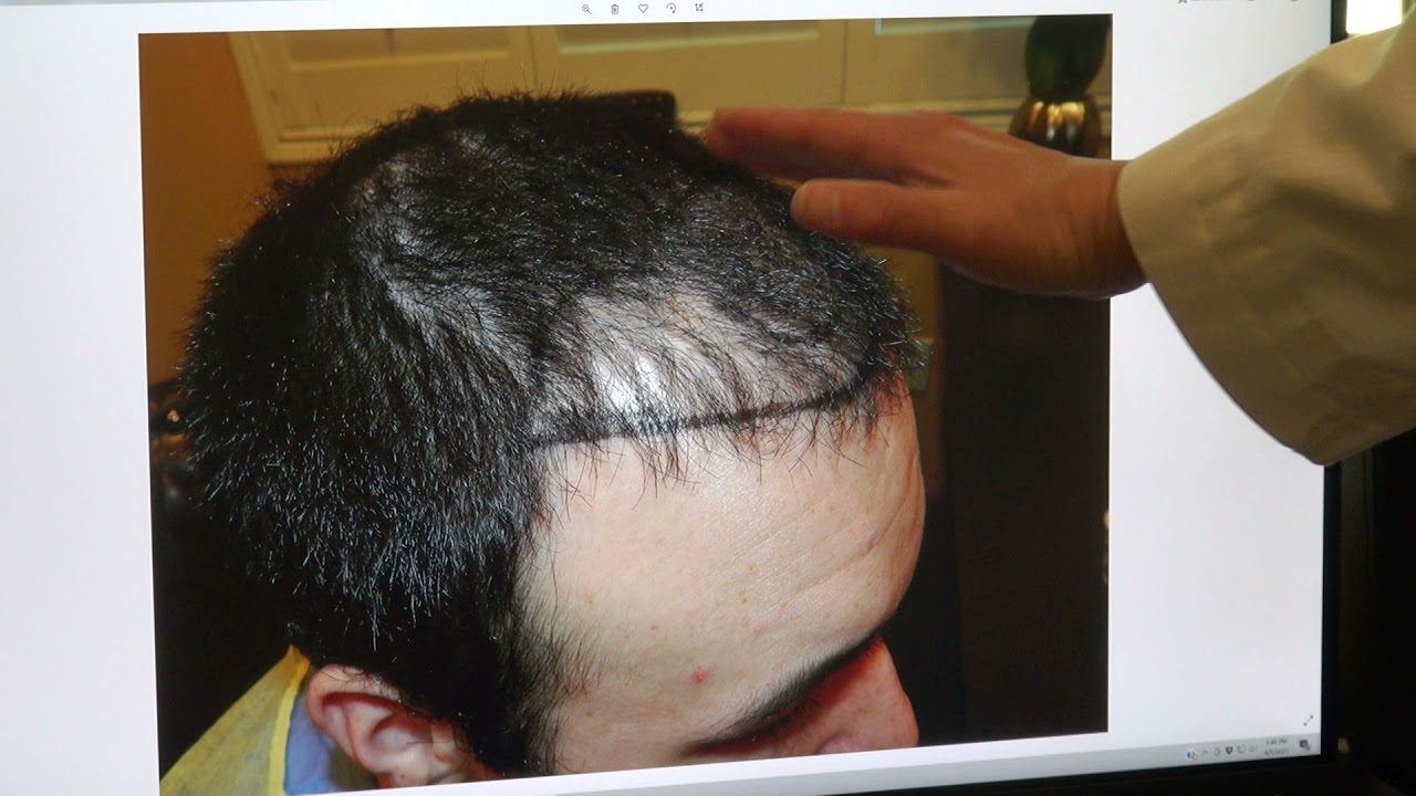 Frontal Corners Temple Edges Bald Hair Loss Restored by Hair Transplant