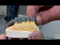 Metal 3D Printing In Dental One Stop Dental Solution SLM DMLS PBF HBD Metal 3D Printer Metal 3D Printing In Dental One Stop Dental Solution SLM DMLS PBF HBD Metal 3D Printer