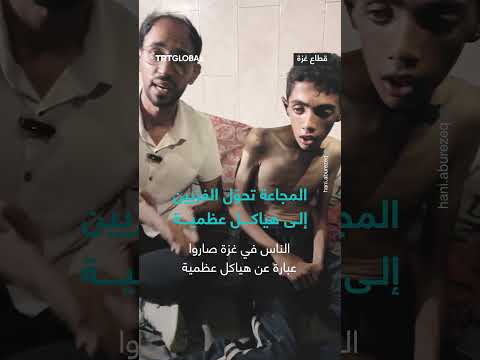 المجاعة تحول الغزيين إلى هياكل عظمية