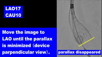 Cusp Overlap Technique with HEARTROID TAVI model
