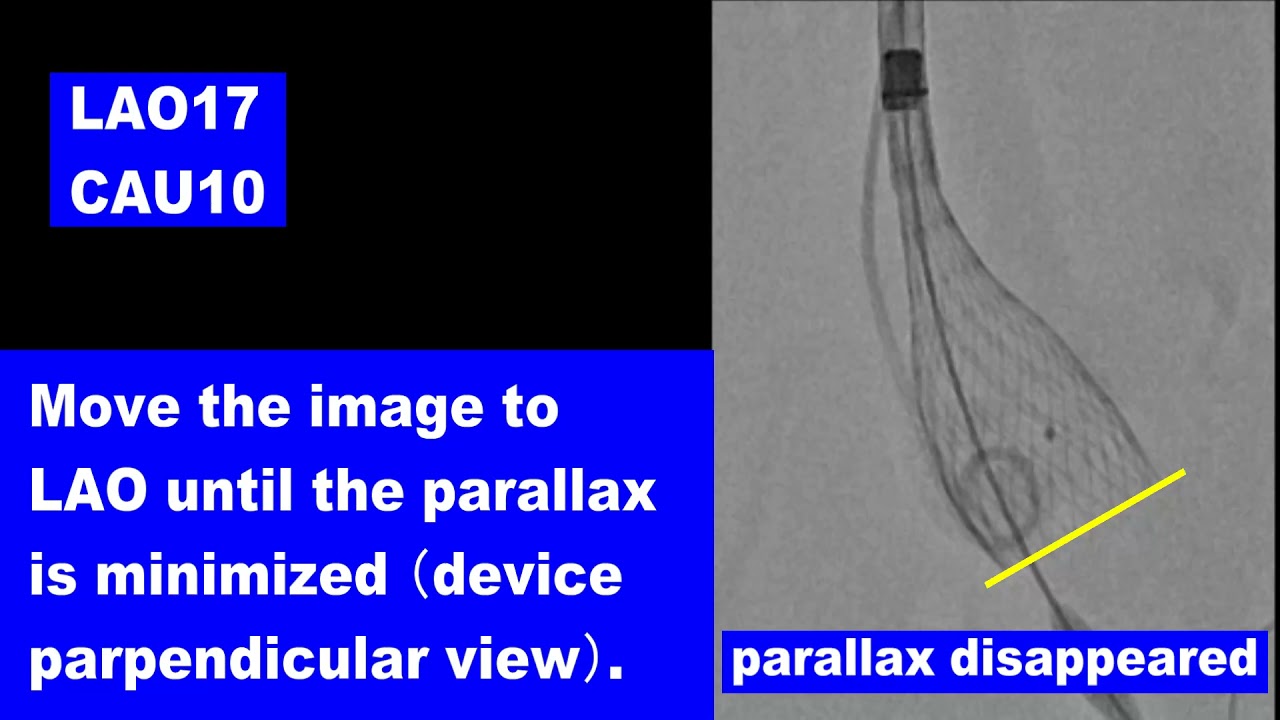Cusp Overlap Technique with HEARTROID TAVI model