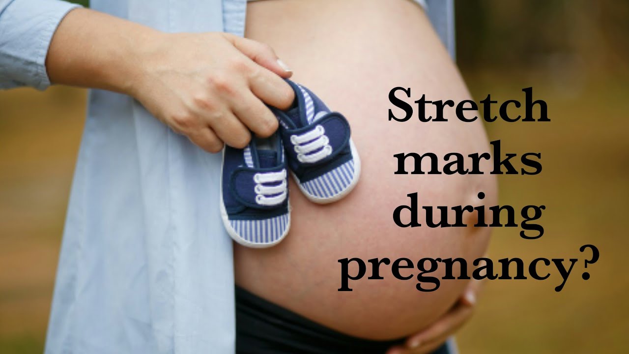 How To Prevent & Remove Stretch Marks at Home post pregnancy / Stretch Mark / Pregnancy Care