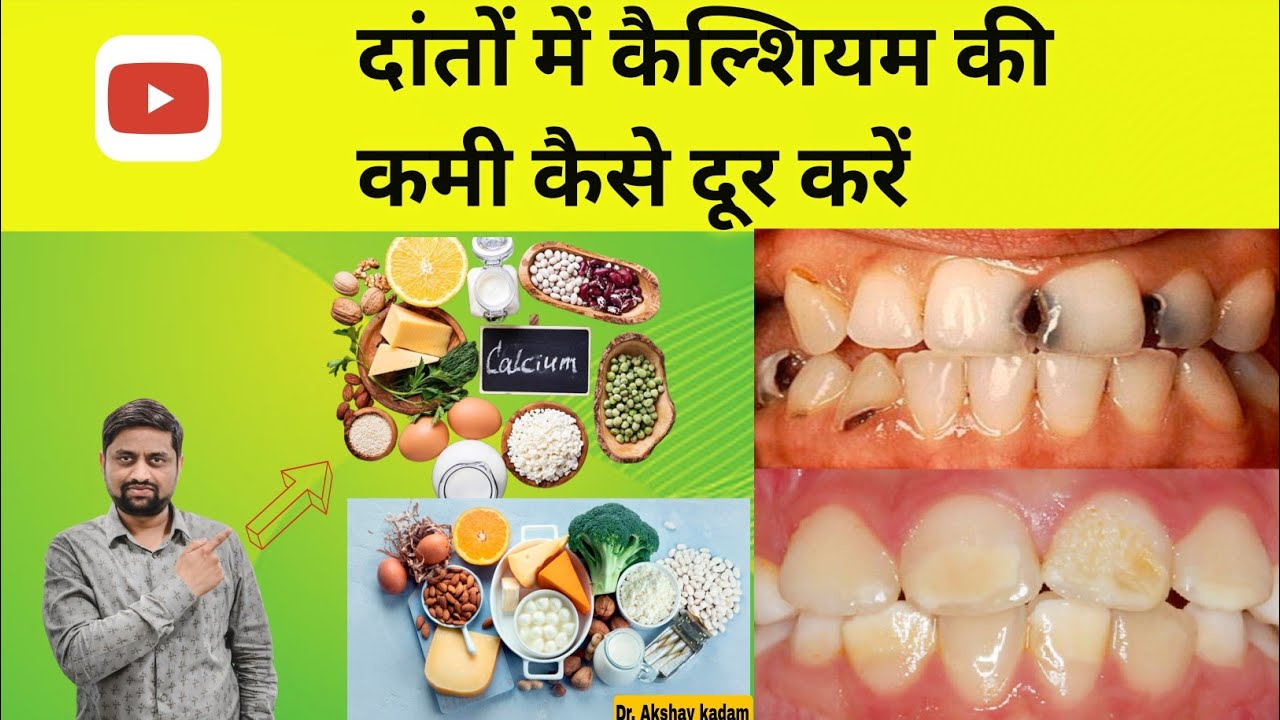 Danto Me Calcium ki kami kaise puri kare?दांतो मे calcium की कमी क्यू