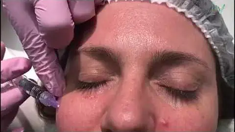 Quanto tempo dura o Skinbooster?
