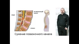 Сужение позвоночного канала.
