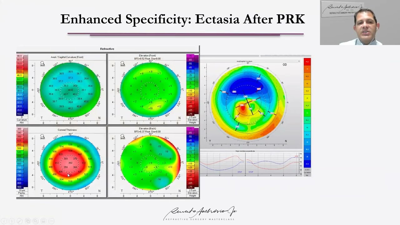 Corneal Biomechanics | R. Ambrosio