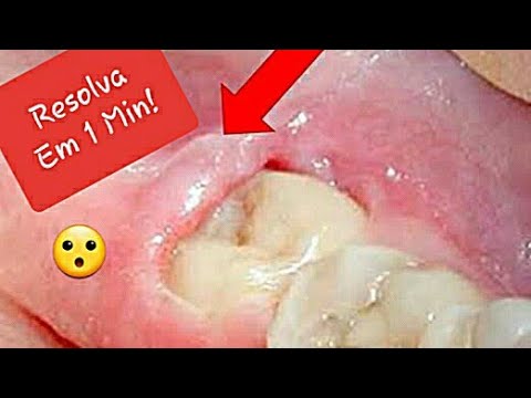 Como ALIVIAR e TIRAR a dor do DENTE SISO! EM 1 MINUTO! - YouTube